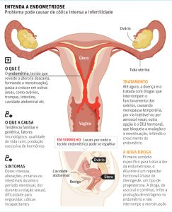 MOB e a endometriose