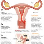 Método de Ovulação Billings e a endometriose