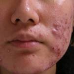 Anticoncepcional é eficaz no tratamento para acne?